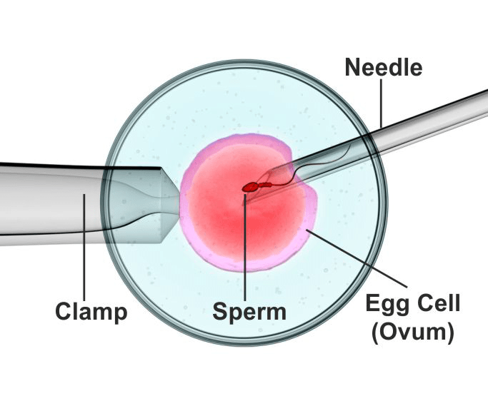 ICSI Treatment